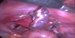 Removal of the right uterine tube - salpingectomy. / Odstranění pravostranného vejcovodu - salpingektomie.