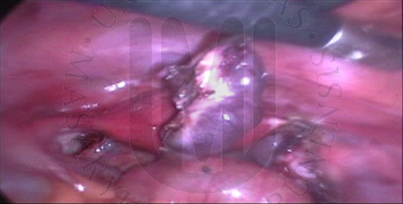 Removal of the right uterine tube