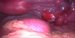 Posterior uterine wall, right ovary and livid right uterine tube with tubal pregnancy. / Zadní stěna děložní, pravé ovarium a lividní vejcovod s tubární graviditou.