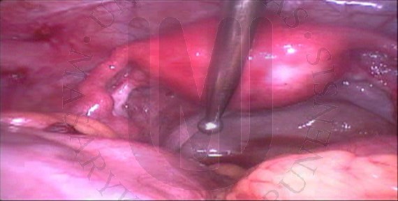Left  uterine tube and uterus