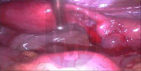 Right uterine tube with tubal pregnancy