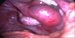 Right uterine tube with the pregnancy in the ampullar part, visible part of the right ovary. / Pravý vejcovod s dilatovanou ampulou s mimoděložní graviditou Pod vejcovodem je část pravého vaječníku.
