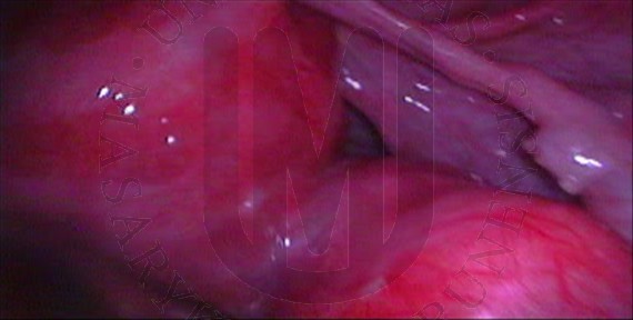 Subserous myom - posterior uterine wall