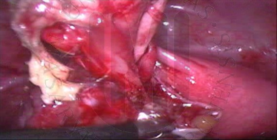Enukleace dermoidální cysty levého ovaria