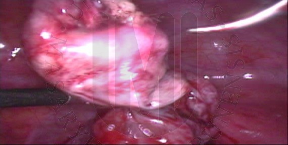Enukleace dermoidální cysty levého ovaria