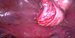 Removal of the left ovarian cyst. There is a uterus and both uterine tubes, we can see vesicouterine pouch. / Odstranění cysty levého ovaria, vidíme dělohy, vejcovody a vesikouterinní pliku.
