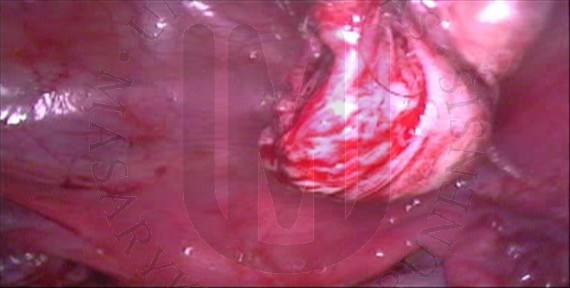 Odstranění dermoidální cysty levého ovaria