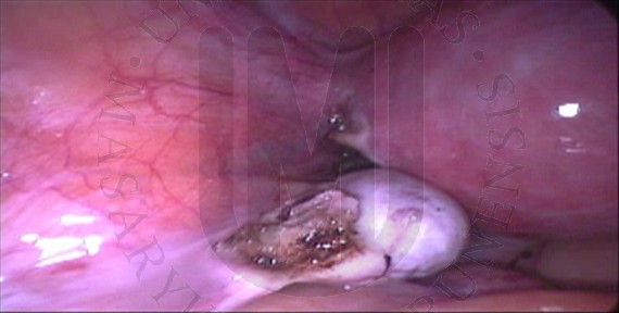 Salpingectomy