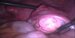 Right uterine tube and the enlarged right ovary with smooth vascular surface. / Pravý vejcovod s pravým zvětšeným vaječníkem.