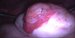 Enlarged right ovary, 5 cm in diameter, ampulla of the uterine tube with fimbriae. / Zvětšený pravý vaječník, 5 cm v průměru, ampula pravého vejcovodu s fimbriemi.