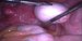 Right ovary, enlarged with dermoidal cyst. Uterus with small subserous myoma at the back. / Zvětšený pravý vaječník s dermoidální cystou. V pozadí děloha s drobným subserózním myomem.