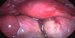 Uterus and both ovaries joint together filling the pouch of Douglas. Ovaries are enlarged with the brownish colour on the surface which is typical for endometriosis.




 / Děloha a oba vaječníky, který jsou navzájem spojeny a vyplňují Douglasovu dutinu. Na povrchu zejména pravého vaječníku je vidět hnědavé zbarvení typické pro endometriózu. Vaječníky jsou výrazně zvětšeny.
