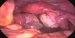 Uterus and both enlarged ovaries. Brown endometrial implants are visible. / Děloha a oboustranně zvětšené vaječníky s hnědými endometriálními ložisky.
