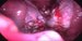 Both ovaries and uterine tubes after cyst exstirpation. / Oba vaječníky a vejcovody po exstirpaci endometriálních cyst.