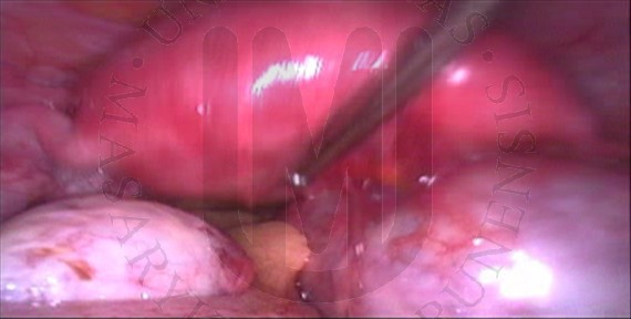 Bilaterální endometriální (Sampsonská) cysta