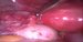 Uterus, left ovary and left uetrine tube. / Děloha, levý vaječník a vejcovod.