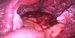 Left ovary and uterine tube, the pouch of Douglas and rigth ovary. / Levý vaječník a vejcovod, Douglasova dutina se sanquinolentním výpotkem a pravý vaječník.