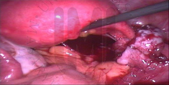 Endometriální cysta
