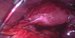 Uterus and left uterine horn, no left uterine tube present (salpingectomy was performed 4 years ago), blood in the pouch of Douglas, livid and dilated right uterine tube. / Děloha a levý roh děložní bez levého vejcovodu, který byl odstraněn před 4 roky. Tmavá krev v Douglasově dutině, lividní a rozšířený pravý vejcovod.