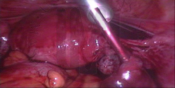 Tubární gravidita