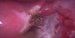 Detail of roght cornual part of the uterus. / Detail pravého rohu děložního.