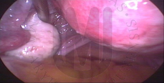 Left ovary and uterine tube 