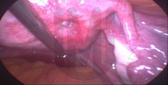Endometriální ložisko v jizvě po myomektomii