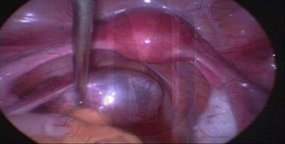 Paratubal cyst on the left