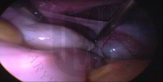Levý vaječník a paratubární cysta vlevo