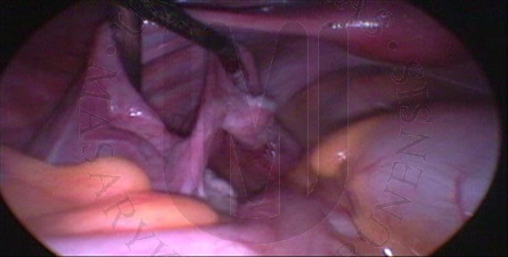 Left  uterine tube after cyst removal