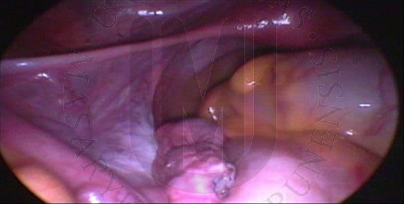 Left  uterine tube after cyst removal