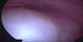 Uterine cavity filled with the leiomyoma - visible stalk. / Dutina děložní vyplněna myomem vycházejícím le levé hrany děložní, viditelná stopka myomu.