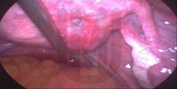 Endometrial implant in the scarf after myomectomy