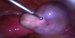 Right ovary enlarged by follicular and dermoid cyst. / Pravý vaječní zvětšený folikulární i dermoidální cystou.