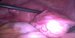 Enlarged right ovary with the ampullar part of the uteirne tube. Uterus with the small subserous myoma. / Zvětšený pravý vaječník, ampulární část vejcovodu a děloha s drobným subserźním myomem.