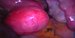 Subserous leiomyoma, right ovary and uterine tube filled with contrast fluid during patency test. / Subserózní myom, pravé ovarium a pravý vejcovod naplněný kontrastní látku, která vytéká z ampuly vejcovodu.