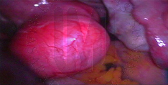 Subserózní myom ze zadní děložní stěny