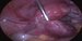 Uterus and dilated left uterine tube. / Děloha a masivně dilatovaný levý vejcovod.