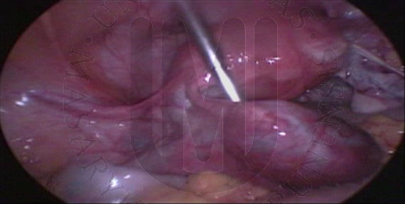 Tubární gravidita
