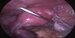 Right ovary of normal size and shape,  right uterine tube was removed 4 years ago due to tubal pregnancy. / Pravý vaječník normální velikosti a tvaru, pravý vejcovod byl odstraněný před 4 roky z důvodu pravostranné tubární gravidity.