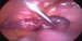 Uterus, right ovary and the right uterine tube of livid color dilated with the tubal pregnancy. / Děloha, pravý vaječník a vejcovod, který je lividně zbarvený a dilatován mimoděložní graviditou.