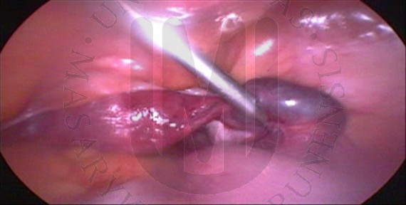 Tubární gravidita vpravo