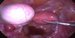 Uterus and the right uterine tube of normal shape with no abnormalities, left ovary with the cyst. / Děloha a pravý vejcovod normální velikosti a tvaru bez abnormit. Levý vaječník s cystou.