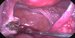 Left uterine tube and the rest of the left ovary after cyst removal. / Levý vejcovod a zbytek levého vaječníku po odstranění cysty.