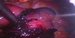 Coagulated blood around uterine tube which is livid and dilated with tubal pregnancy. / Krevní koagula okolo lividně zbarveného pravého vejcovodu, který je dilatovaný tubární graviditou.