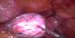 Enlarged left ovary with the endometrial cyst. / Zvětšené levé ovarium s endometriální cystou.