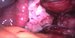Left uterine tube, left ovary after exstirpation and the pouch of Douglas after adhesiolysis. / Část levého vejcovodu, levý vaječník po exstirpaci cysty a Douglasova dutina po adhesiolýze.