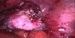 Right ovary after exstirpation of the cyst, numerous endometrial implants. / Pravý vaječník po exstirpaci cysty a četná ložiska endometriózy.