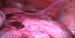 We can see uterus at the back and the surface of the large cyst of the right ovary. / Na snímku můžeme vidět dělohu v pozadí a povrch objemné ovariální cysty pravého ovaria.