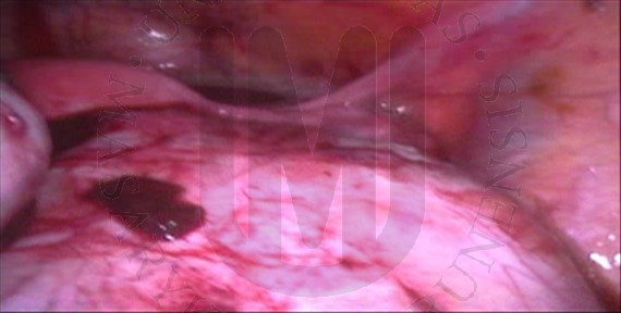Endometriální cysta pravého ovaria